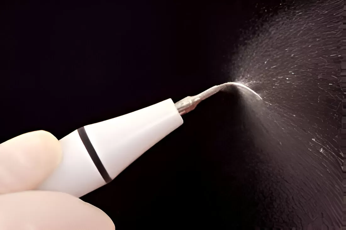 Ультразвуковой скейлинг